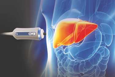 Fibroscan in Bhiwani, Cost of Fibroscan, Fatty Liver Test in Bhiwani, Haryana, Dr Mayank Chugh